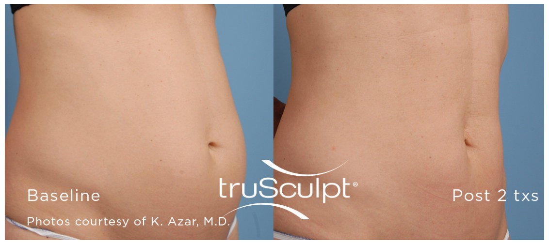 Non Surgical liposuction