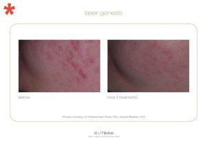 Laser Genesis and diffuse redness