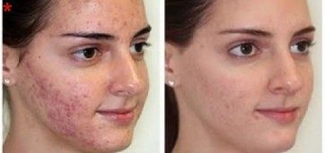 Laser Acne Removal