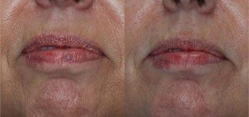 venous lake lip treatment