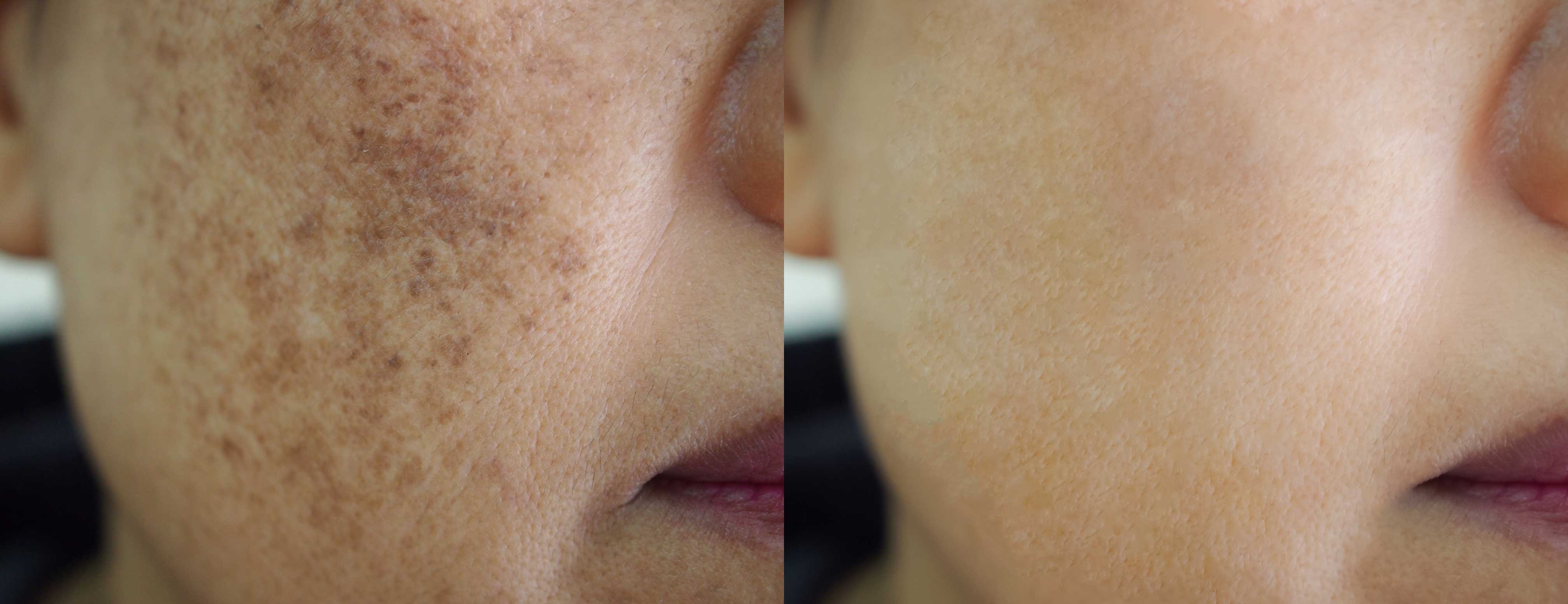 Laser Treatment For Sun Damage Sun Spots Skiin